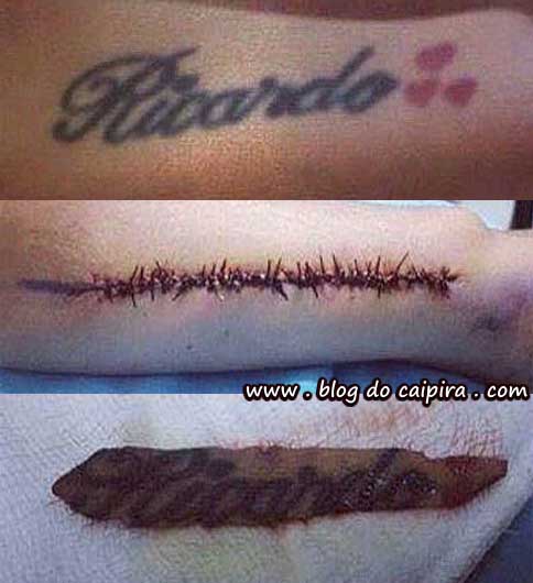 como remover tatuagem
